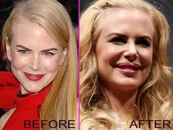 Nicole_Kidman_Plastic_Surgery_before_after